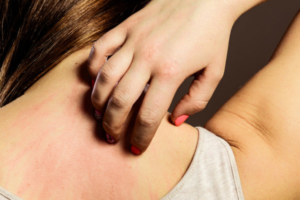 Keto Rash and How To Prevent It