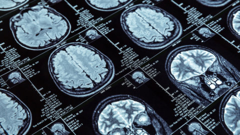 Keto-Mojo-Epilepsy Brain Scan