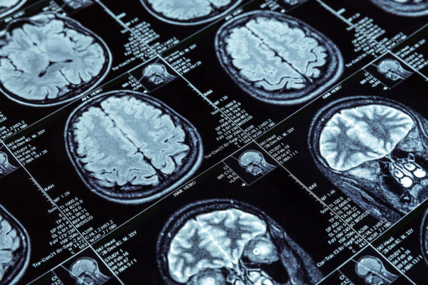 Keto-Mojo-Epilepsy Brain Scan